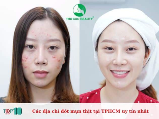 Danh sách các cơ sở đốt mụn thịt uy tín tại TPHCM