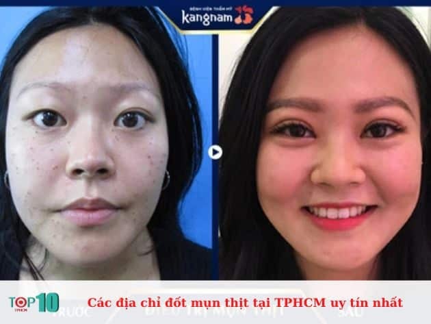 Danh sách các cơ sở đốt mụn thịt uy tín tại TPHCM