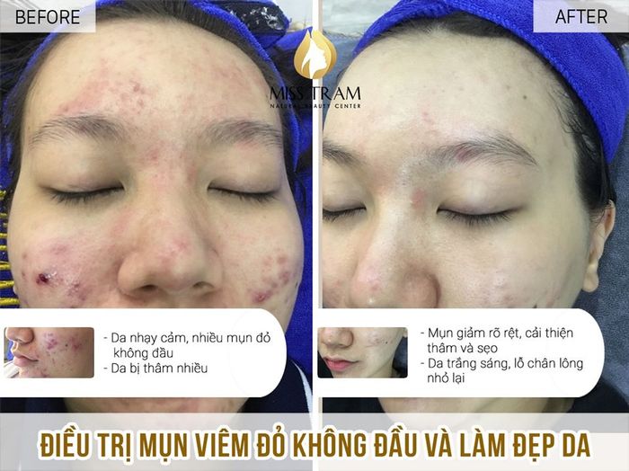 Spa trị mụn tại Quận 1 - Miss Trâm Spa