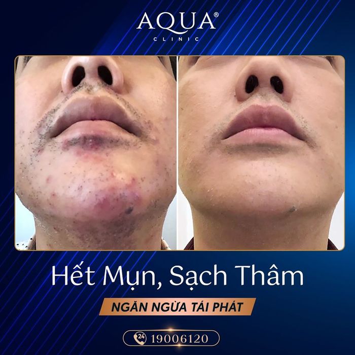 Spa trị mụn tại quận 1 - Aqua Clinic