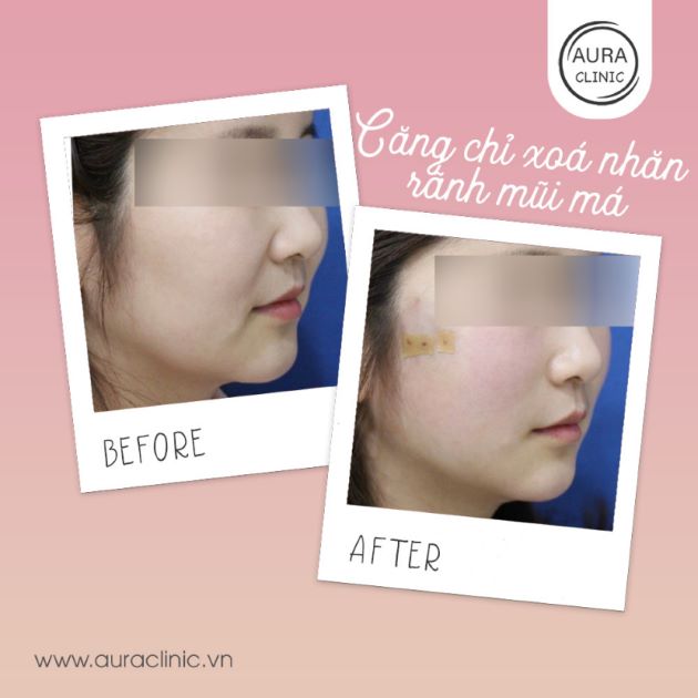 Dịch vụ nâng cơ xóa nếp nhăn vùng mũi và má tại Aura Beauty Clinic | Nguồn: Aura Beauty Clinic