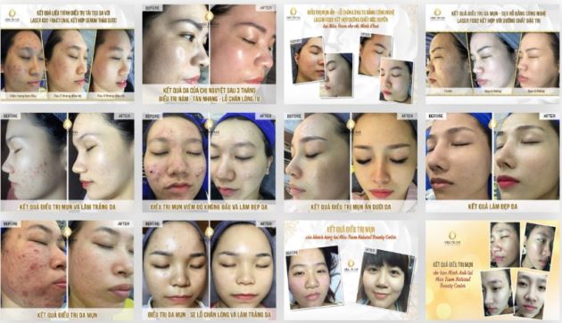 Địa chỉ nâng cơ mặt uy tín tại TPHCM - Miss Trâm Spa | Nguồn: Miss Trâm Spa