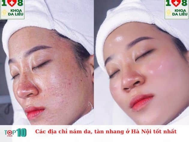 Những địa chỉ hàng đầu điều trị nám da và tàn nhang tại Hà Nội