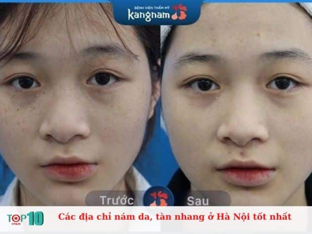 Những địa chỉ hàng đầu điều trị nám da và tàn nhang ở Hà Nội