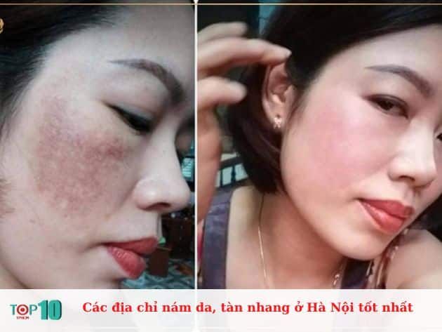 Những địa chỉ điều trị nám và tàn nhang uy tín tại Hà Nội