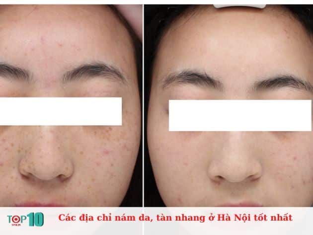 Các địa chỉ trị nám da và tàn nhang uy tín tại Hà Nội