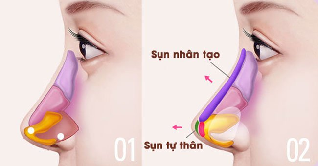 Hình ảnh 2 của nâng mũi bằng sụn nhân tạo