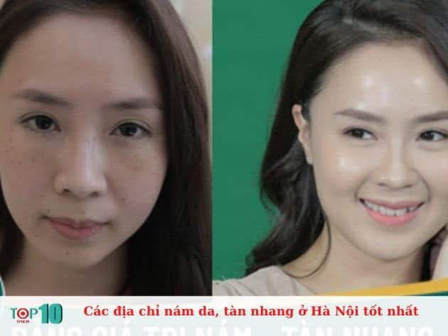 Những địa chỉ điều trị nám da và tàn nhang hàng đầu tại Hà Nội