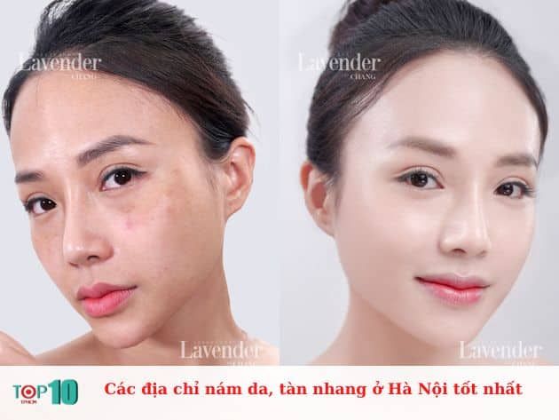 Các địa chỉ trị nám và tàn nhang hàng đầu ở Hà Nội