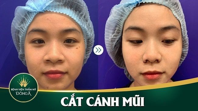 Khách hàng thực hiện thu gọn cánh mũi tại Thẩm mỹ viện Đông Á