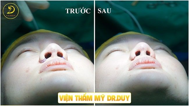 Hình ảnh trước và sau khi thực hiện thu gọn cánh mũi bởi bác sĩ Duy.