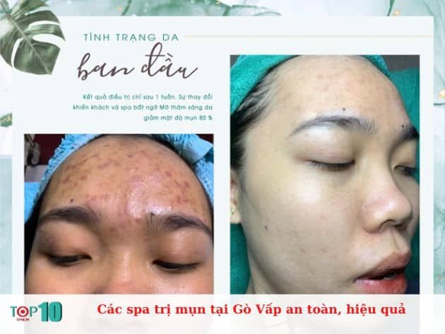 Những spa trị mụn an toàn và hiệu quả tại Gò Vấp