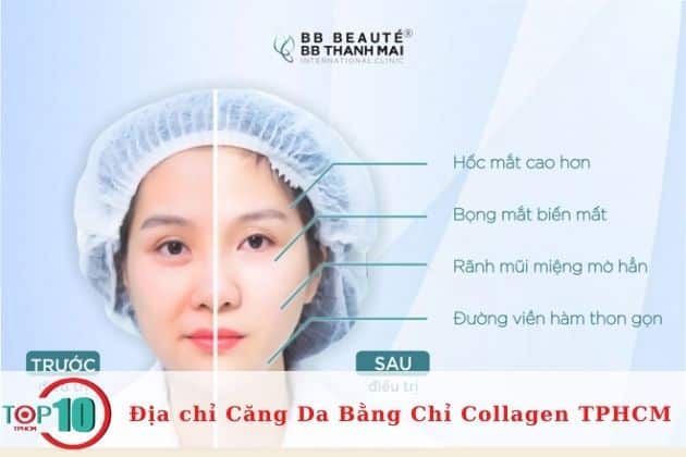 Cơ sở căng da mặt bằng chỉ collagen tại TPHCM | Nguồn: Thẩm mỹ viện BB Beaute – BB Thanh Mai