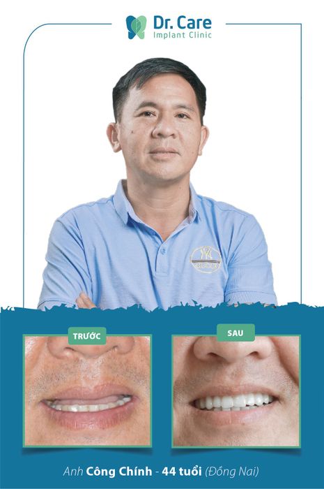 Dr. Care - Phương Pháp Cấy Ghép Răng Không Đau hình 2