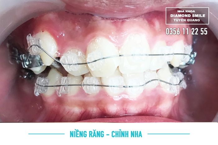 Hình ảnh 1 của Nha khoa Diamond Smile Tuyên Quang