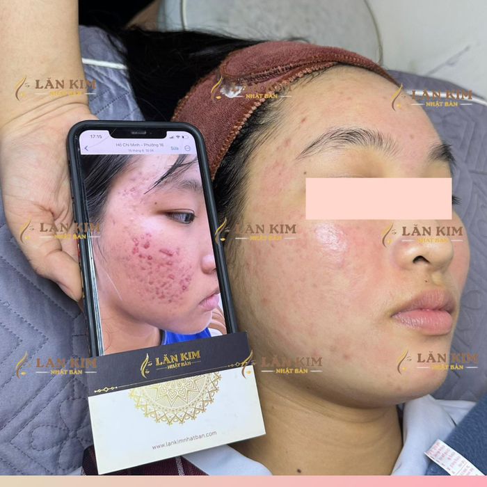 Hình ảnh Lăn Kim Nhật Bản 2