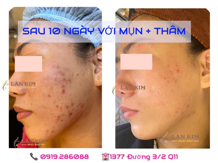 Hình ảnh Lăn Kim Nhật Bản