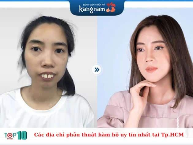 Các địa chỉ phẫu thuật hàm hô uy tín tại TP.HCM