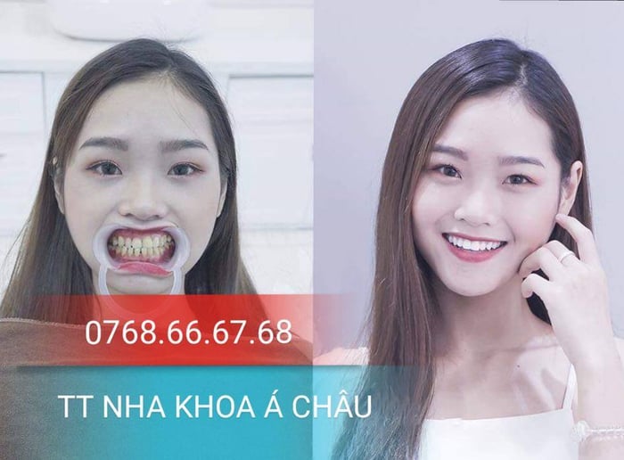 Hình ảnh Nha khoa Á Châu Vũng Tàu 1