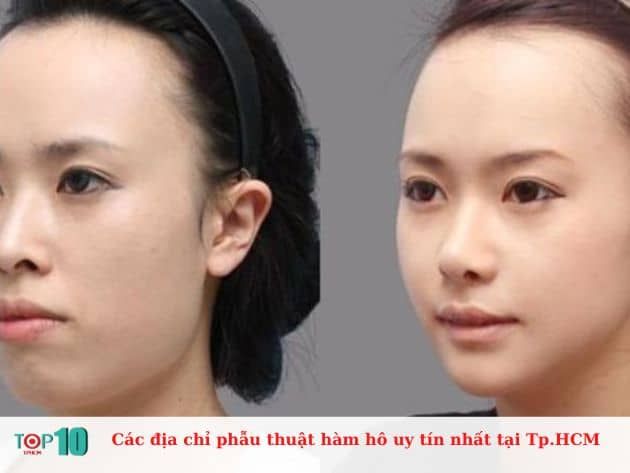 Danh sách các cơ sở phẫu thuật hàm hô uy tín nhất tại TP.HCM