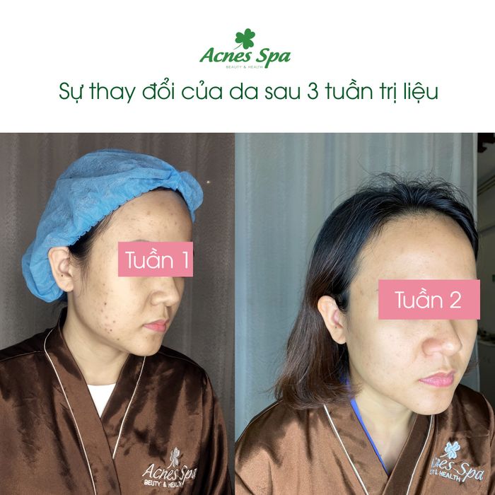 Hình ảnh 2 của Acnes Spa