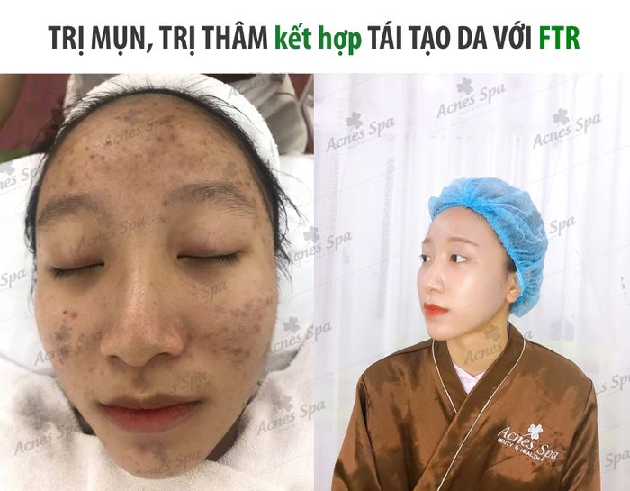 Hình ảnh 1 của Acnes Spa