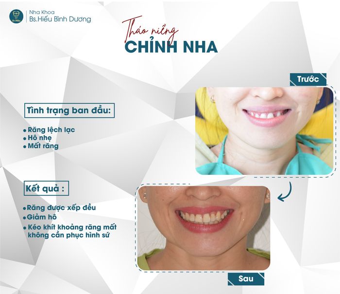 Hình ảnh 2 tại Nha Khoa BS. Hiếu Bình Dương