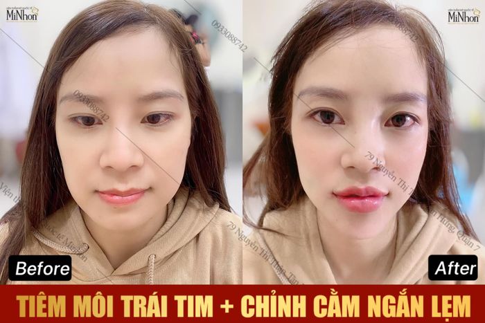 Ảnh 2 tại Viện Thẩm Mỹ Quốc Tế Minhon