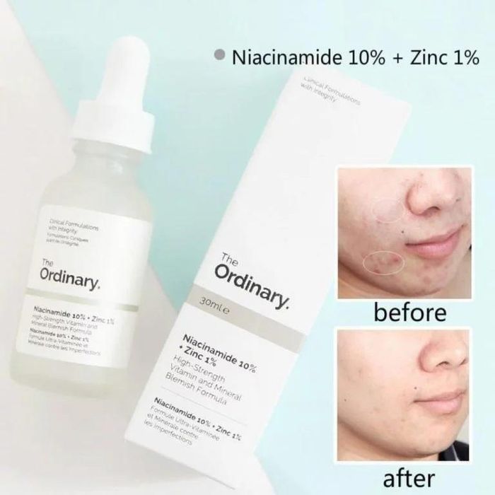 Serum The Ordinary Niacinamide hỗ trợ làm giảm đốm nâu, tàn nhang và vết thâm mụn hình 2