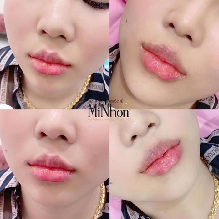 Viện Thẩm Mỹ Quốc tế MiNhon - Hình 1