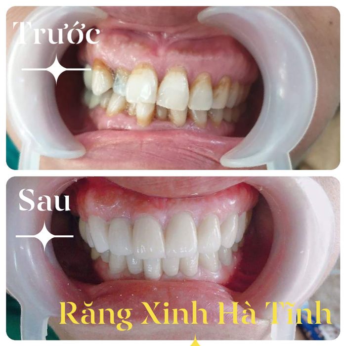 Ảnh 1 của Nha Khoa Răng Xinh - Hà Tĩnh