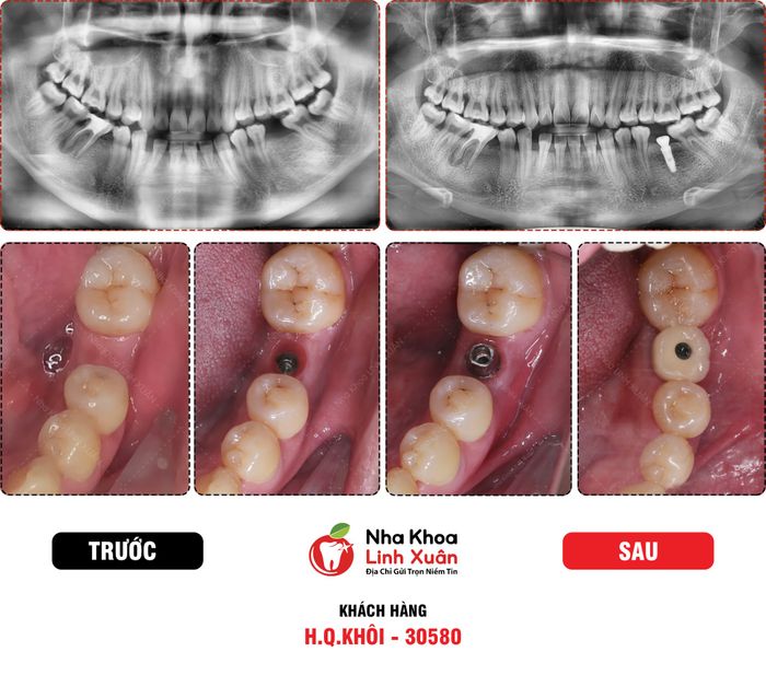 Ảnh về Nha Khoa LINH XUÂN