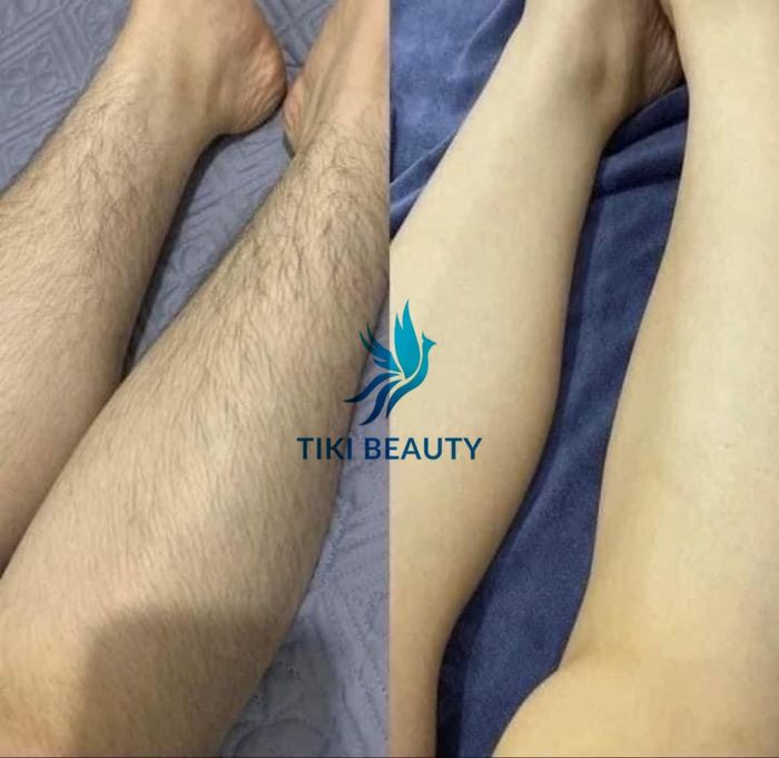 Hình ảnh 3 của Thẩm Mỹ Ngọc Hân TiKi Beauty