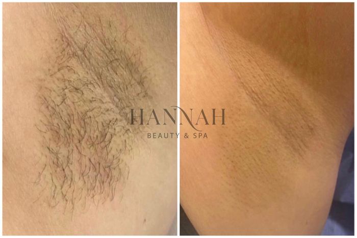 Hannah Beauty & Spa - Hình 1