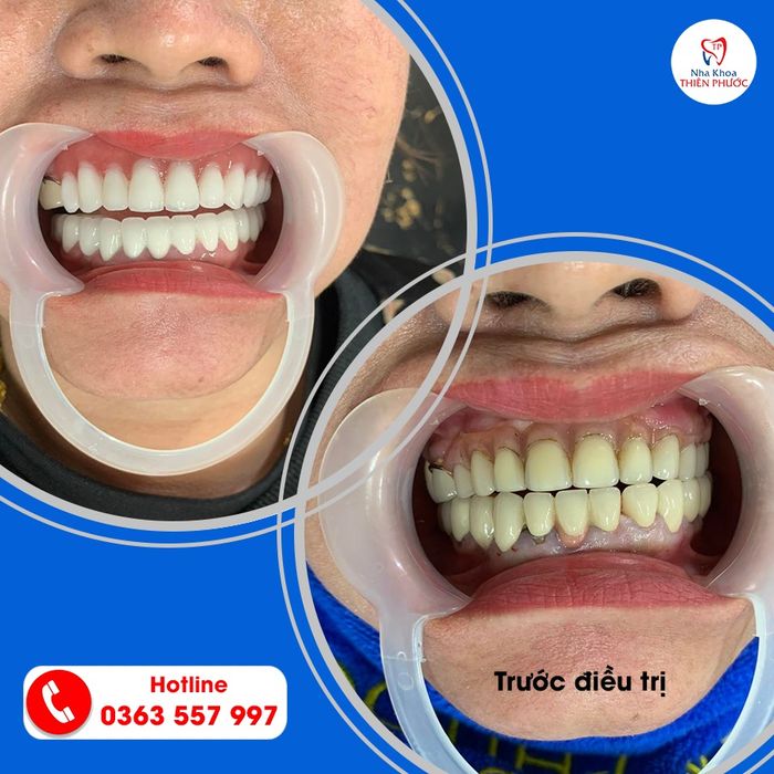 Hình ảnh 2 của Nha Khoa Thiên Phước