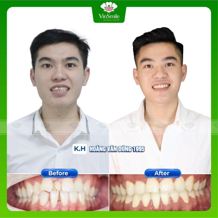 Hình ảnh Nha Khoa Bắc Ninh - VinSmile Tỏa Sáng Nụ Cười Việt 2