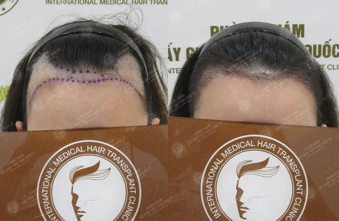 Phòng Khám Cấy Ghép Tóc Y Học Quốc Tế hình ảnh 2