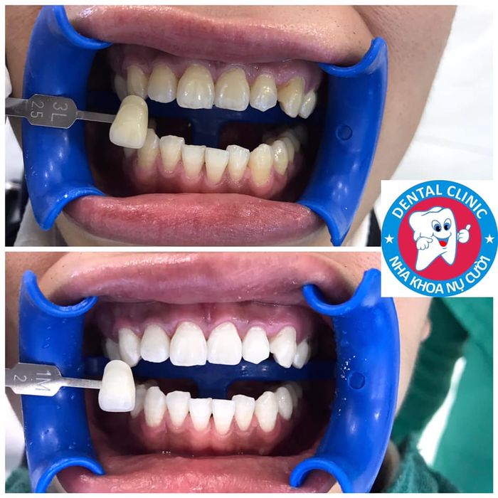 Ảnh 2 Nha Khoa Nụ Cười Đà Lạt