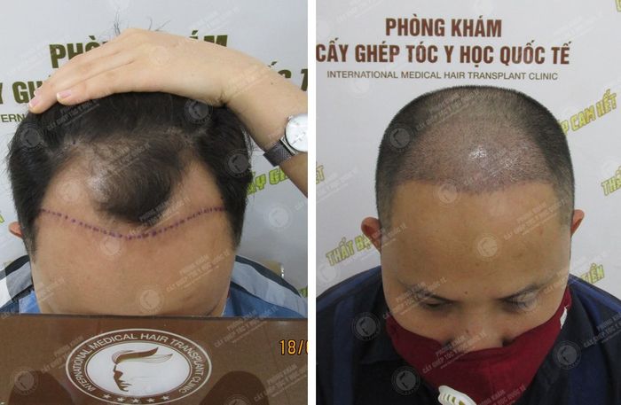 Phòng Khám Cấy Ghép Tóc Y Học Quốc Tế hình ảnh 1