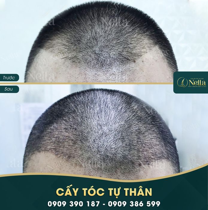 Hình ảnh Viện Cấy Tóc Tự Thân Nella 1