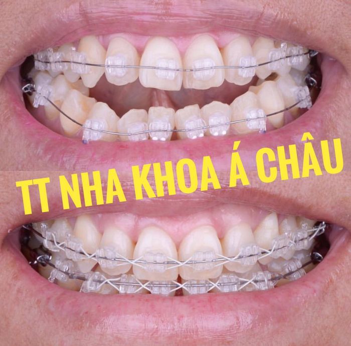 Hình ảnh Nha khoa Á Châu Vũng Tàu 2