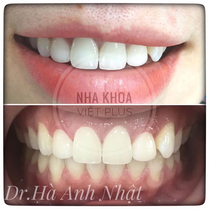 Ảnh 1 tại Nha Khoa Việt Plus