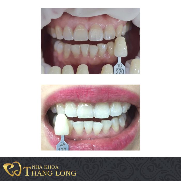 Hình ảnh 1 của Nha Khoa Thăng Long