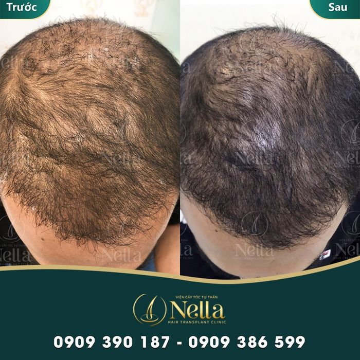 Hình ảnh Viện Cấy Tóc Tự Thân Nella 3