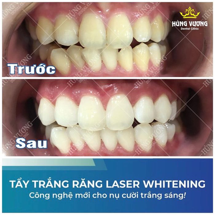 Hình ảnh 2 của Nha Khoa Hùng Vương Việt Trì