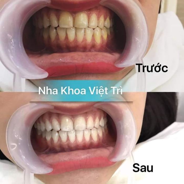 Hình ảnh 2 của Phòng khám Nha Khoa Việt Trì - B/s Hưng