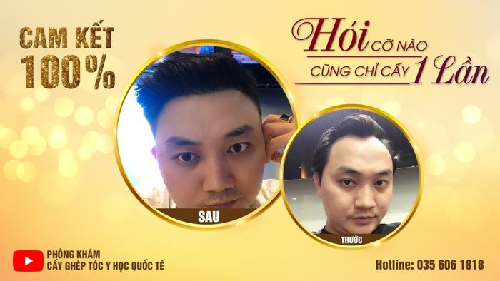 Phòng Khám Cấy Ghép Tóc Y Học Quốc Tế hình ảnh 3