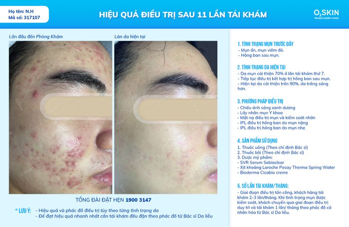 Hình ảnh minh hoạ (Nguồn: Phòng Khám Da Liễu O2 SKIN) - hình 1
