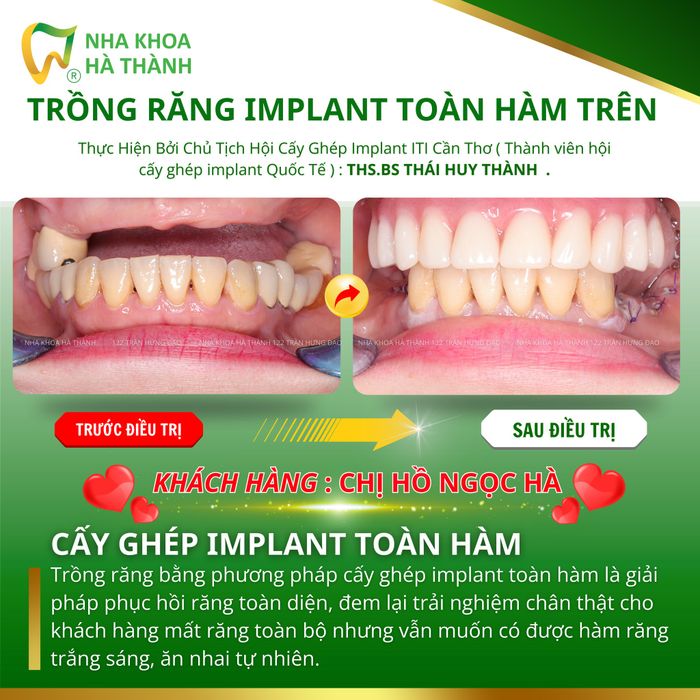Hình ảnh Nha Khoa Hà Thành 1