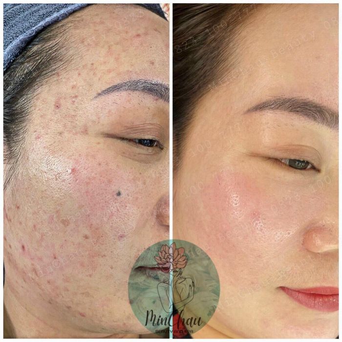 Hình ảnh thứ 2 tại MinChau Beauty & Spa